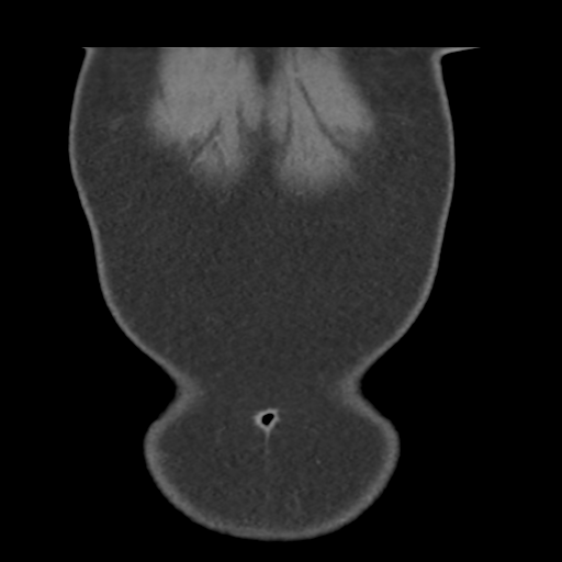 File:Normal CT renal artery angiogram (Radiopaedia 38727-40889 B 4).png