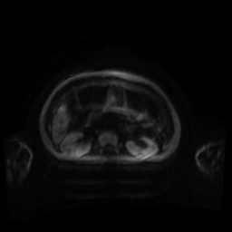 Normal MRI abdomen in pregnancy (Radiopaedia 88001-104541 Axial DWI 119).jpg