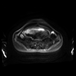 Normal MRI abdomen in pregnancy (Radiopaedia 88001-104541 Axial DWI 56).jpg