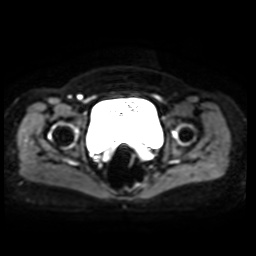 Normal MRI abdomen in pregnancy (Radiopaedia 88005-104548 Axial DWI 13).jpg