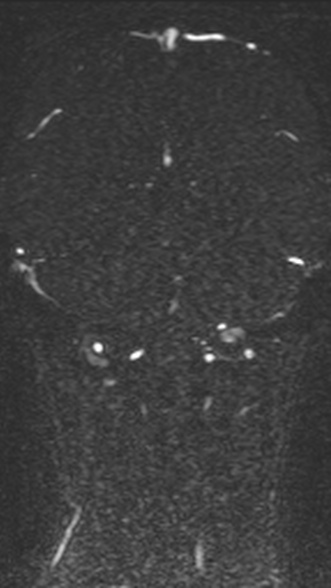 Normal MRI brain with MRV- teenager (Radiopaedia 49425-54553 Coronal MRV 169).jpg
