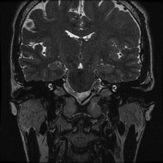 Normal MRI petrous (Radiopaedia 91317-108949 Coronal T2 40).jpg