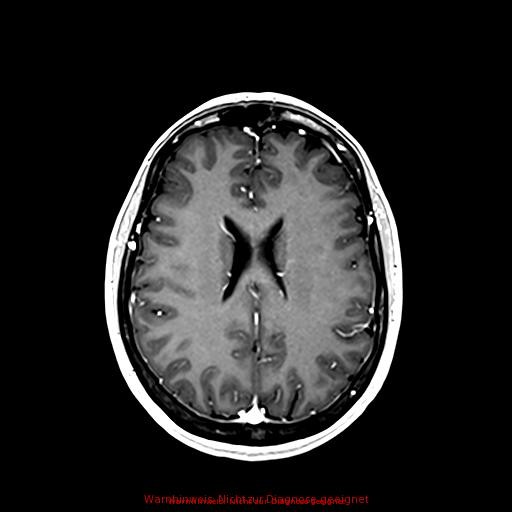 Normal adult brain MRI (non-enhanced and contrast-enhanced) (Radiopaedia 75262-86379 Axial T1 C+ 123).jpg