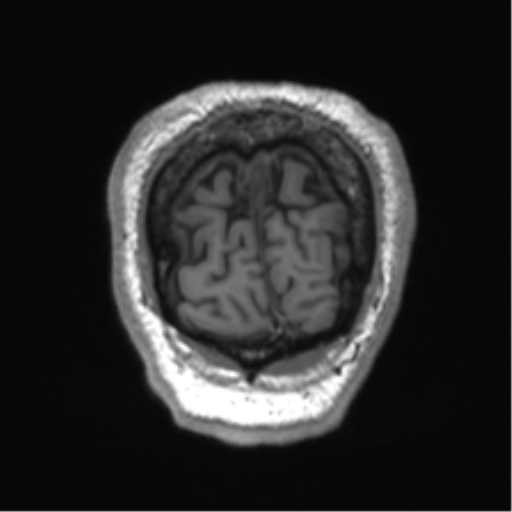 Normal brain MRI (non-focal epilepsy protocol) (Radiopaedia 53917-60040 Coronal T1 8).png