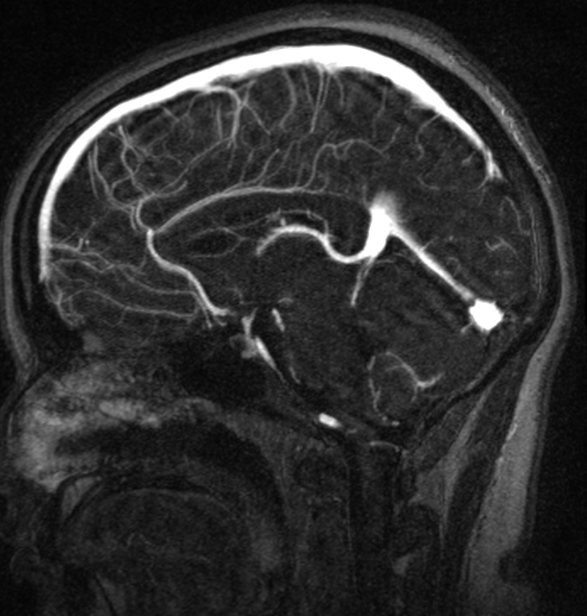 Normal brain MRI and venogram (Radiopaedia 39554-41862 Sagittal MRV 32).jpg