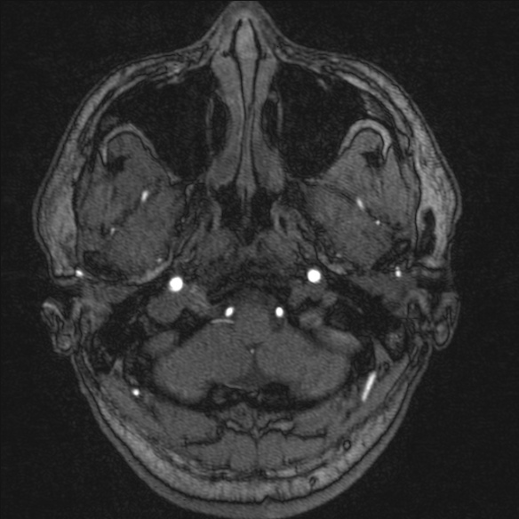 Normal brain MRI including MRA (Radiopaedia 48748-53763 Axial MRA 13).jpg