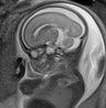 File:Normal brain fetal MRI - 22 weeks (Radiopaedia 50623-56050 Sagittal T2 Haste 14).jpg