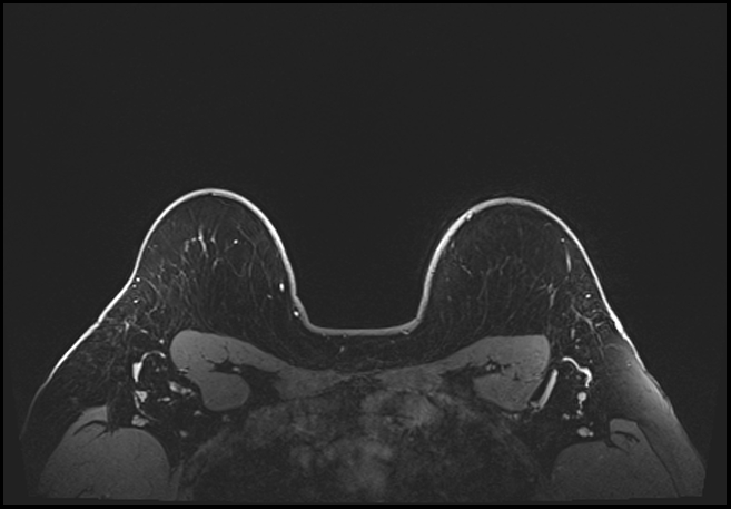 Normal breast MRI - dense breasts (Radiopaedia 80454-93850 C 192).jpg