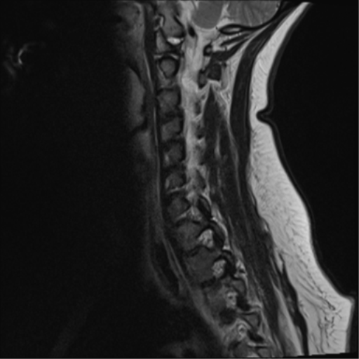 File:Normal cervical spine MRI (including Dixon) (Radiopaedia 42762-45925 Dixon- in-phase 5).png