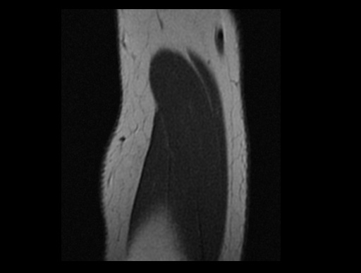 File:Normal elbow arthrograms (Radiopaedia 75550-86805 Sagittal PD 5).jpg