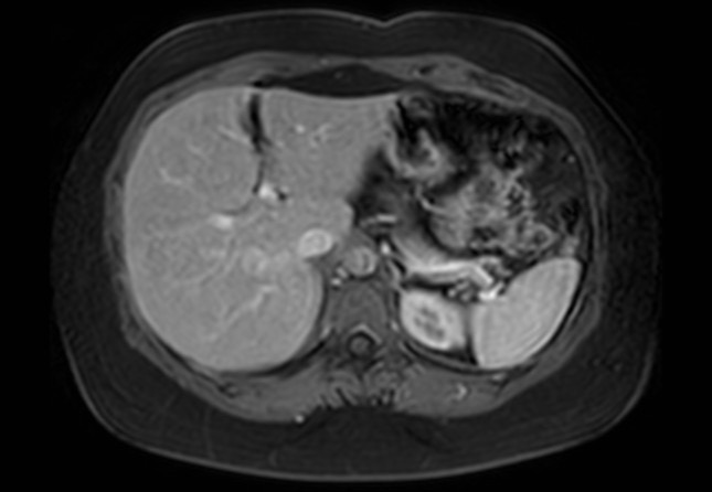 Normal liver MRI with Gadolinium (Radiopaedia 58913-66163 J 49).jpg