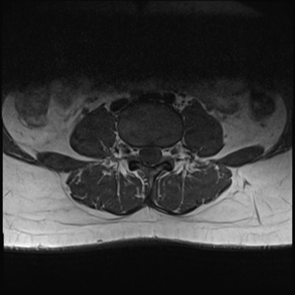 File:Normal lumbar spine MRI- 3 T (Radiopaedia 53280-59250 Axial 16).jpg