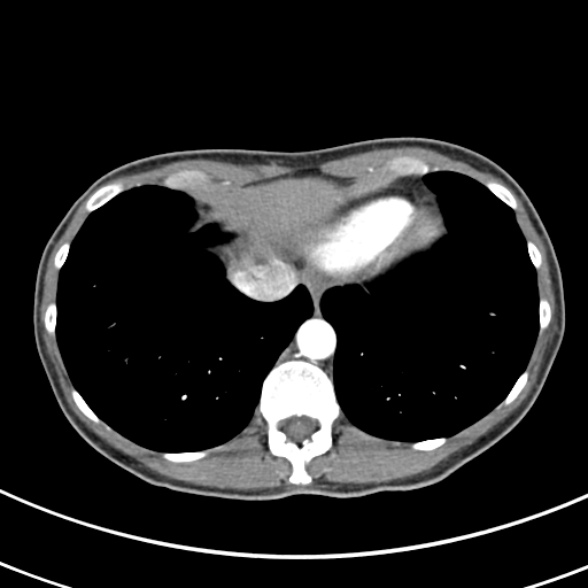 File:Normal multiphase CT liver (Radiopaedia 38026-39996 B 5).jpg