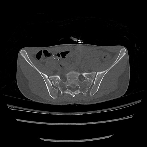Normal pelvis CT (Radiopaedia 51471-57236 Axial bone window 31).jpg