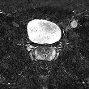 File:Normal prostate (MRI) (Radiopaedia 29986-30535 Axial STIR 11).jpg