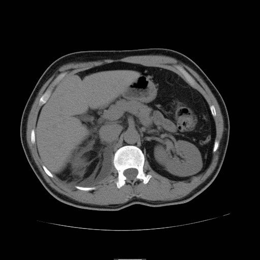 File:Obstructed kidney with perinephric urinoma (Radiopaedia 26889-27066 Axial non-contrast 13).jpg