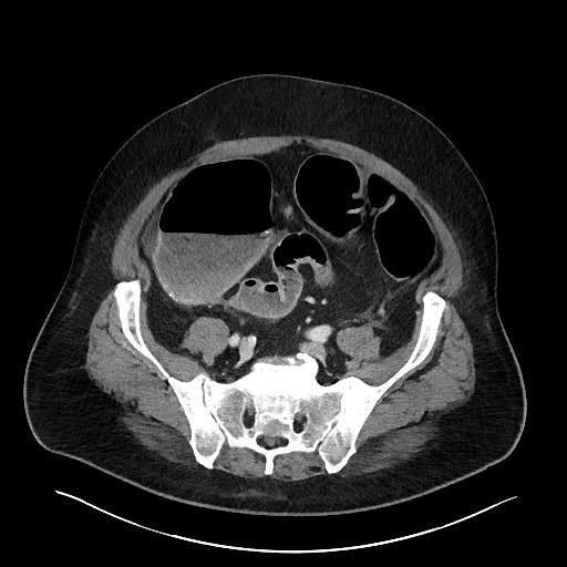 File:Obstructing sigmoid adenocarcinoma (Radiopaedia 58465-65619 A 122).jpg