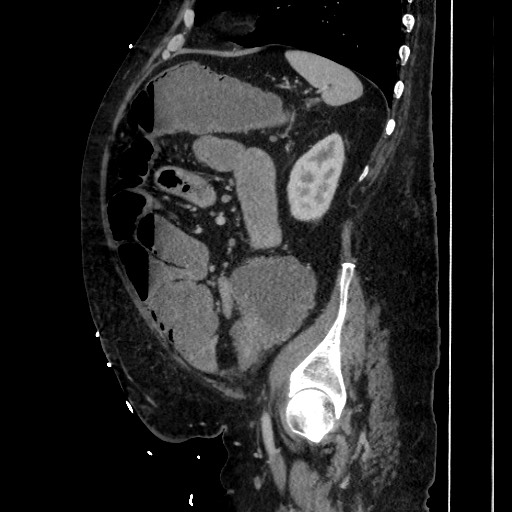 Obstructive colonic diverticular stricture (Radiopaedia 81085-94675 C 168).jpg