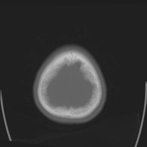 File:Obstructive hydrocephalus (Radiopaedia 30453-31119 Axial bone window 4).jpg
