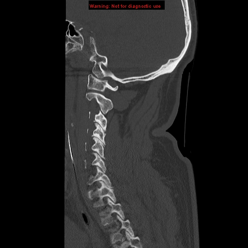 File:Occipital condyle fracture (Radiopaedia 18366-18208 Sagittal bone window 26).jpg