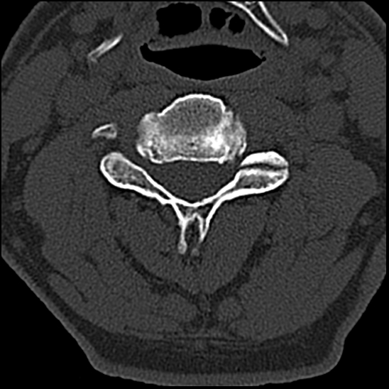 Occipital condyle fracture (type 1) (Radiopaedia 87670-104084 Axial bone window 42).jpg