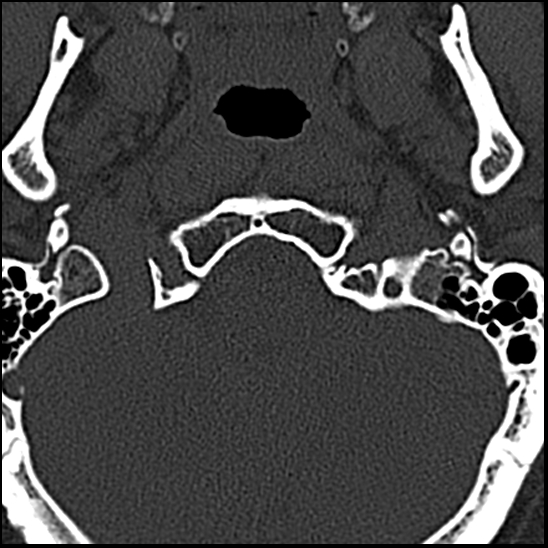 Occipital condyle fracture (type 1) (Radiopaedia 87670-104084 Axial bone window 5).jpg