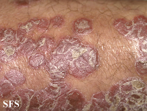 File:Psoriasis (Dermatology Atlas 35).jpg