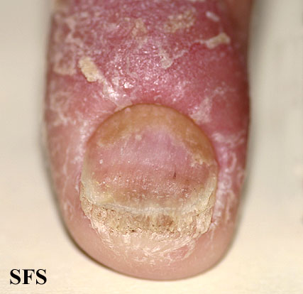 File:Psoriasis (Dermatology Atlas 40).jpg