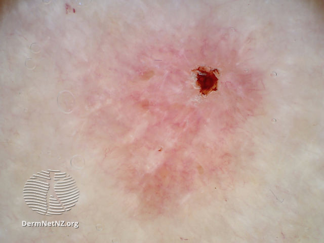 File:Superficial basal cell carcinoma dermoscopy (DermNet NZ sbcc-arm-dn).jpg