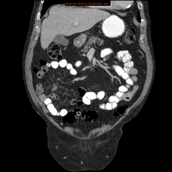 File:Abdominal aortic aneurysm (Radiopaedia 10122-10660 Coronal C+ portal venous phase 2).jpg