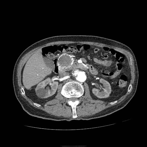 Abdominal aortic aneurysm (Radiopaedia 13341-13340 Axial C+ arterial phase 80).jpg