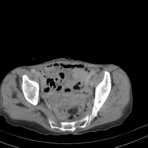 File:Abdominal aortic aneurysm (Radiopaedia 20827-20742 Axial C+ delayed 31).jpg