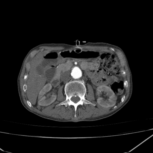 Abdominal aortic aneurysm (Radiopaedia 23703-23856 Axial C+ arterial phase 29).jpg
