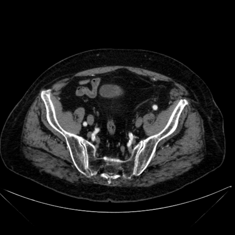Abdominal aortic aneurysm (Radiopaedia 25855-26001 Axial C+ arterial phase 110).jpg