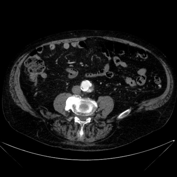 Abdominal aortic aneurysm (Radiopaedia 25855-26001 Axial C+ arterial phase 83).jpg