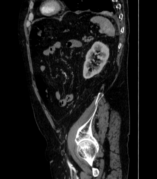 Abdominal aortic aneurysm (Radiopaedia 25855-26001 Sagittal C+ arterial phase 65).jpg