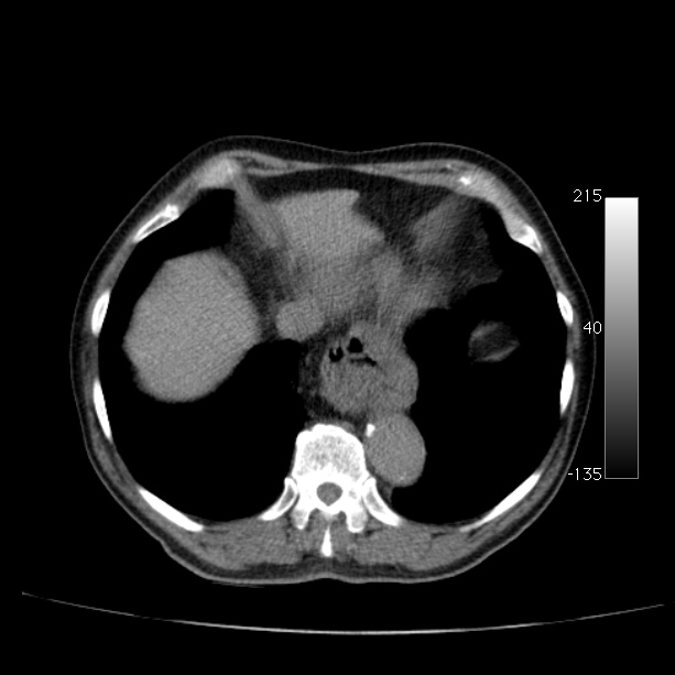 Abdominal aortic aneurysm (Radiopaedia 29248-29660 Axial non-contrast 8).jpg