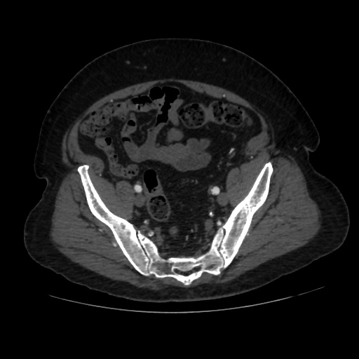File:Abdominal aortic aneurysm (Radiopaedia 57318-64259 Axial C+ arterial phase 60).jpg