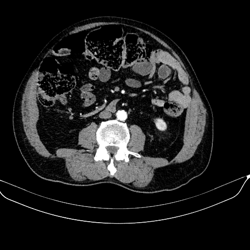 Abdominal aortic aneurysm (Radiopaedia 67117-76452 Axial C+ arterial phase 74).jpg