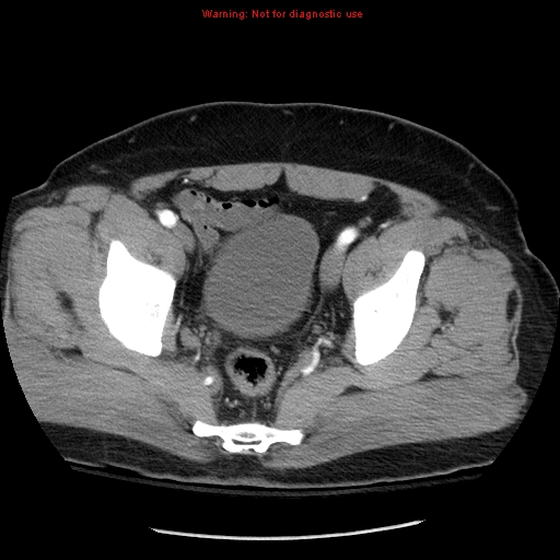 File:Abdominal aortic aneurysm (Radiopaedia 8190-9038 Axial C+ arterial phase 73).jpg