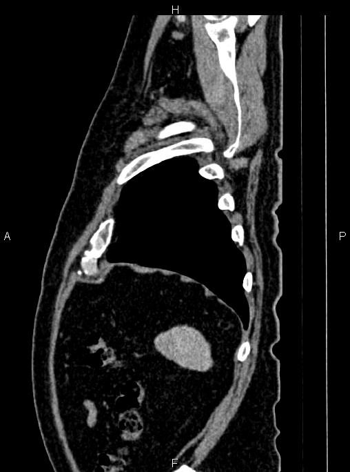 Abdominal aortic aneurysm (Radiopaedia 83094-97462 Sagittal renal cortical phase 109).jpg
