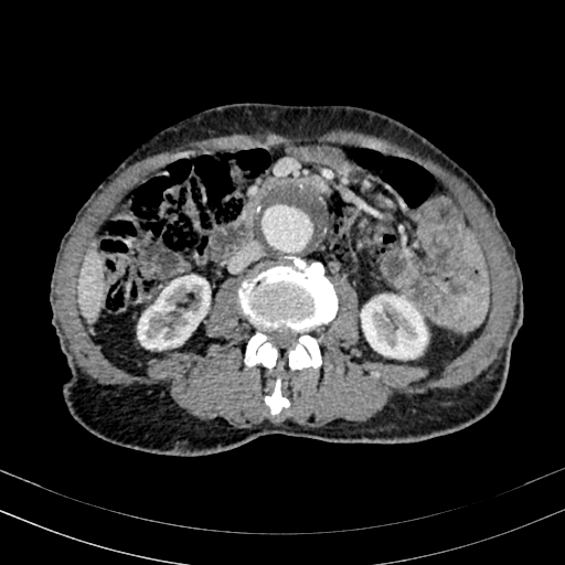 File:Abdominal aortic aneurysm (Radiopaedia 83581-98689 Axial C+ portal venous phase 58).jpg