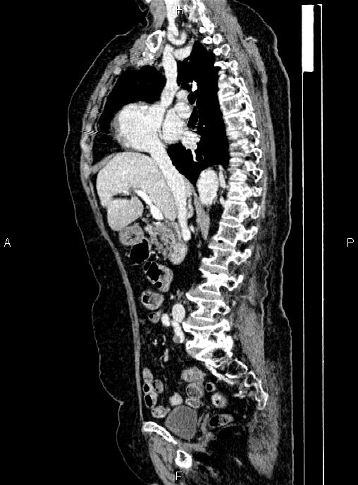 Abdominal aortic aneurysm (Radiopaedia 85063-100606 Sagittal C+ arterial phase 33).jpg