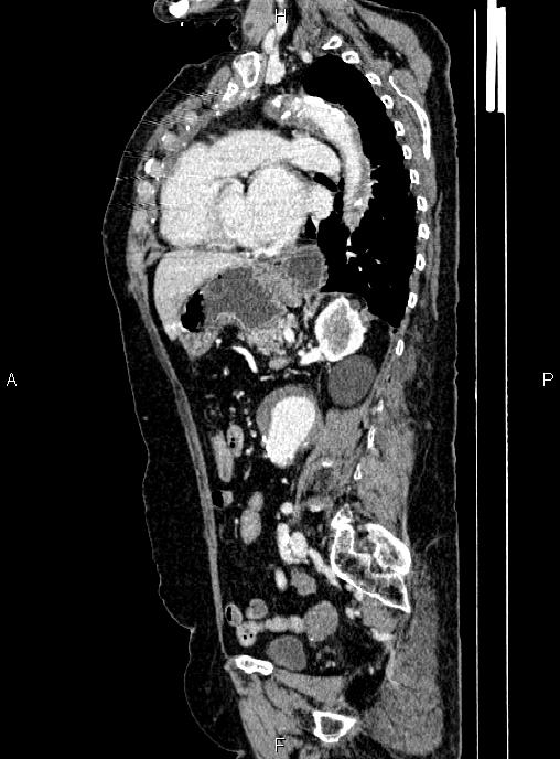 Abdominal aortic aneurysm (Radiopaedia 85063-100606 Sagittal C+ arterial phase 52).jpg