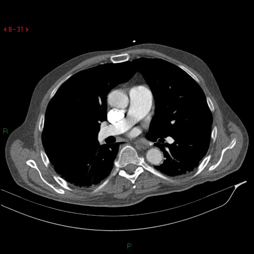 File:Abdominal aortic aneurysm rupture with aortocaval fistula (Radiopaedia 14897-14841 Axial C+ arterial phase 31).jpg