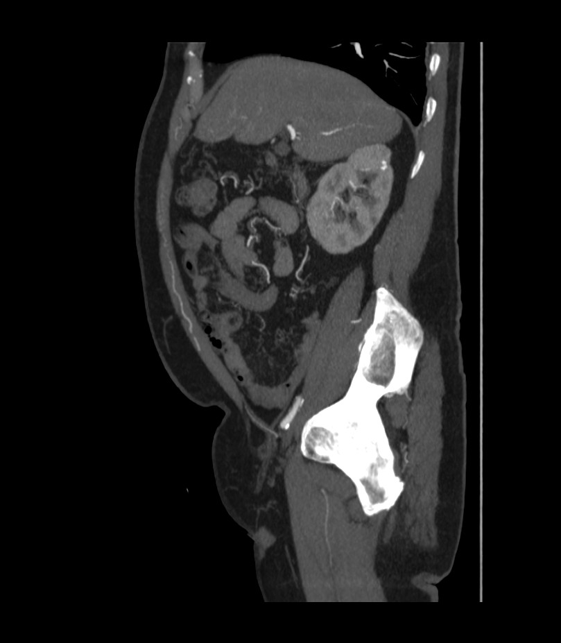 Abdominal aortic aneurysm with thrombus fissuration (Radiopaedia 46218-50618 Sagittal C+ arterial phase 18).jpg