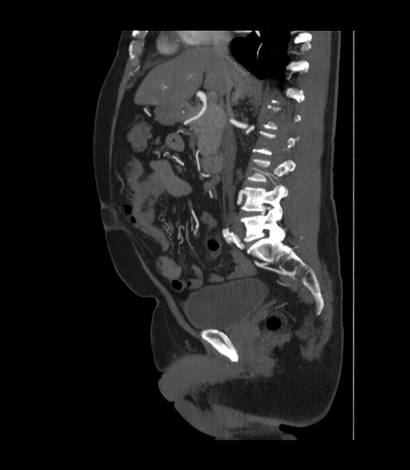 Abdominal aortic aneurysm with thrombus fissuration (Radiopaedia 46218-50618 Sagittal C+ arterial phase 26).jpg