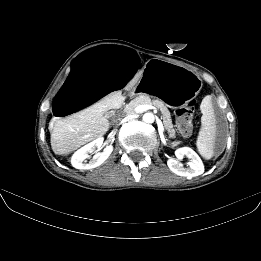 File:Abdominal collection due to previous cecal perforation (Radiopaedia 80831-94320 Axial C+ portal venous phase 72).jpg