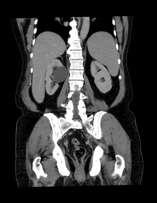 Abdominal lymphoma - with sandwich sign (Radiopaedia 53486-59492 C+ portal venous phase 17).jpg