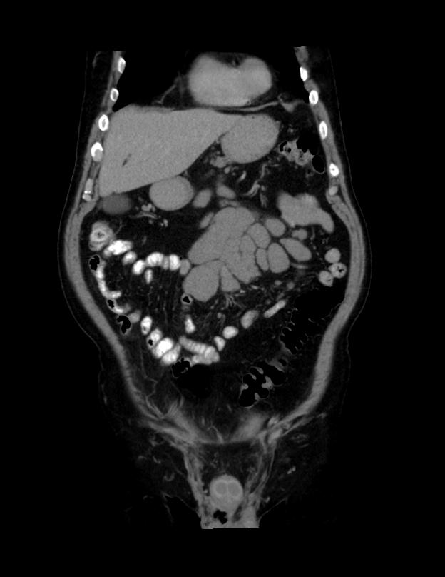 Abdominal lymphoma - with sandwich sign (Radiopaedia 53486-59492 C+ portal venous phase 44).jpg